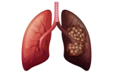 Cancer du poumon