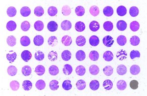 Custom service : Antibody validation in IHC on TMA